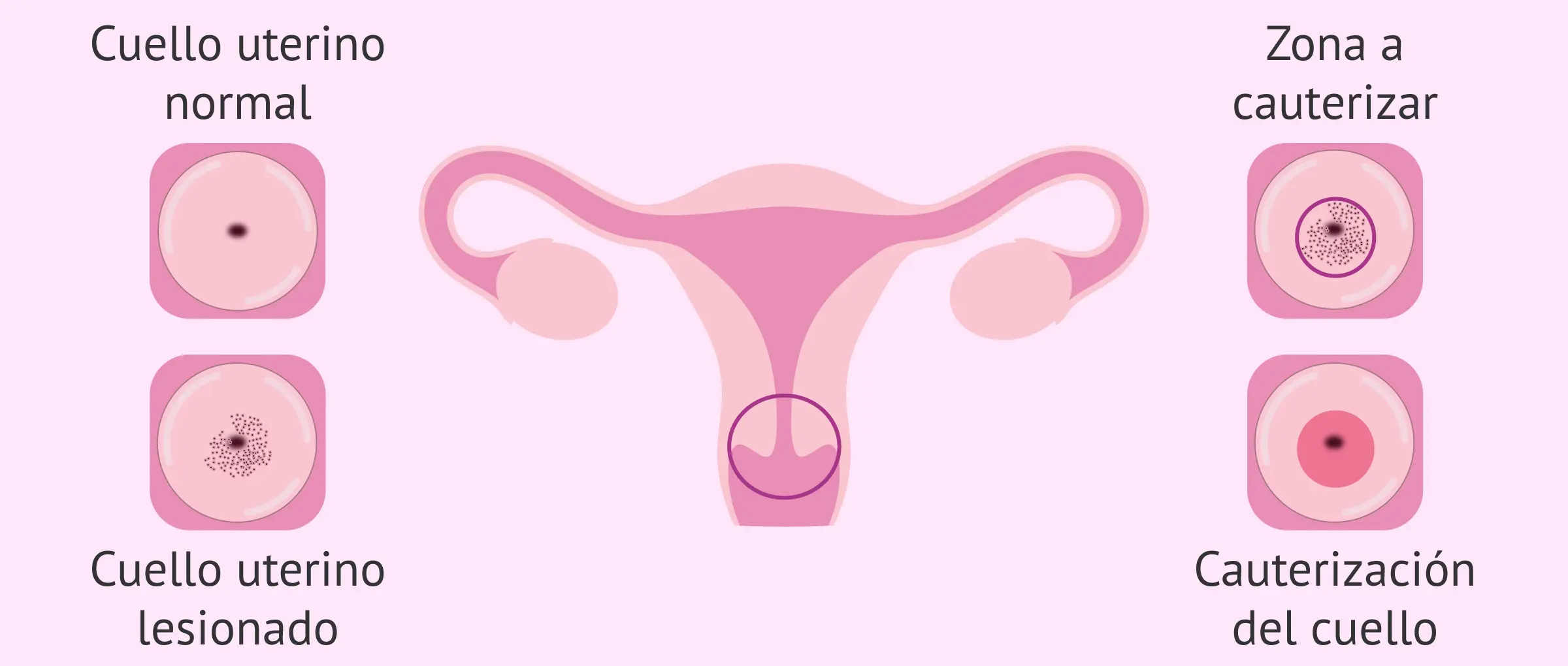 baterias en el cuello uterino - Cómo saber si tengo una infección en el útero