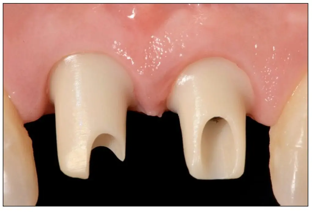 elsevier implantes dentales baterias - Cuál es el mejor material para los implantes dentales