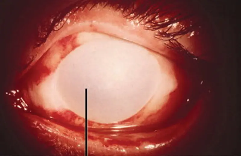 me cayo acido de bateria en el ojo - Cuánto tarda en curarse una quemadura en el ojo